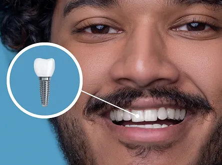 hombre-joven-gran-sonrisa-demostrando-su-implante-dental