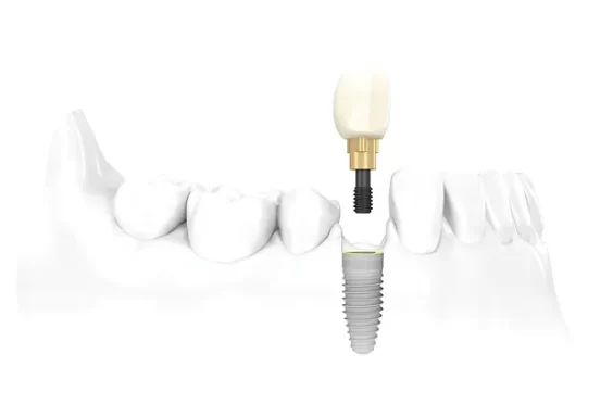 Dental-Implants-Indianapolis UNITARIO_jp