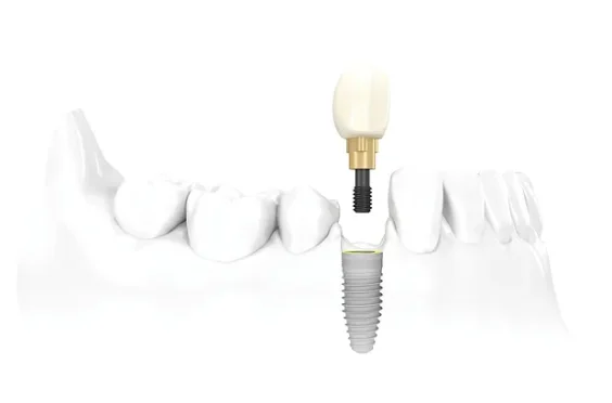 Dental-Implants-Indianapolis UNITARIO_jp