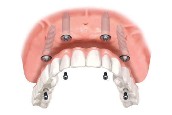 como-se-pone-un-implante-en-24-horas